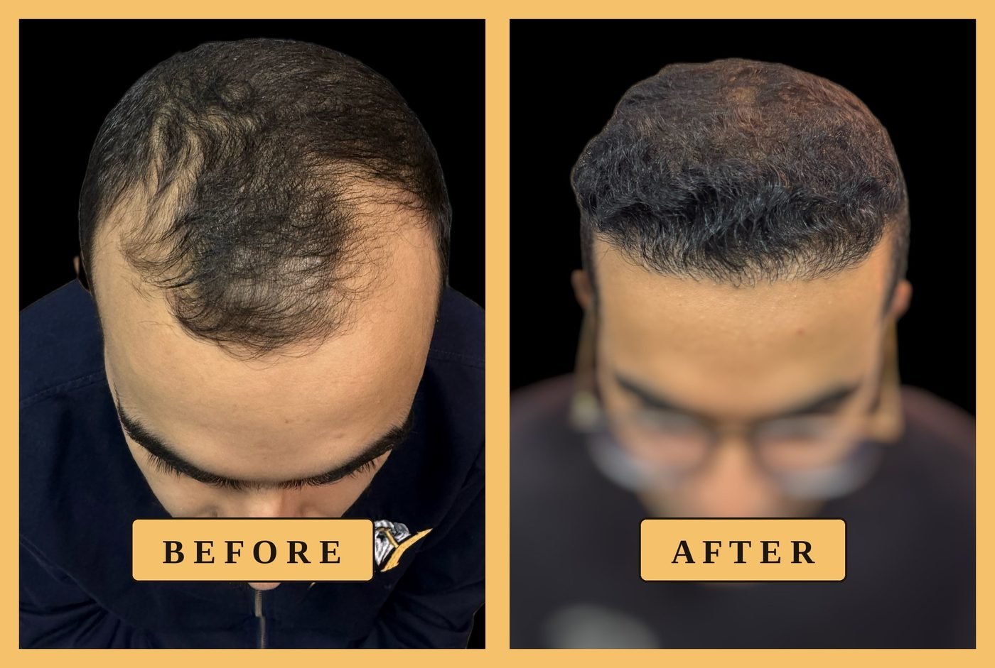 حالة زراعة خط الشعر الأمامي، قبل وبعد